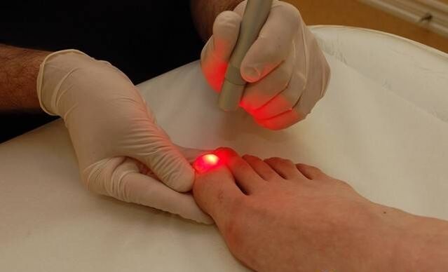 laserová liečba plesní nechtov na nohách