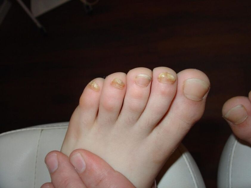 príznaky plesní nechtov na nohách