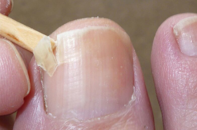 Poškodené nechty sú rizikovým faktorom plesňovej infekcie