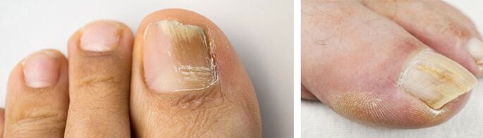 fotografia plesňovej infekcie na nechte palca na nohe