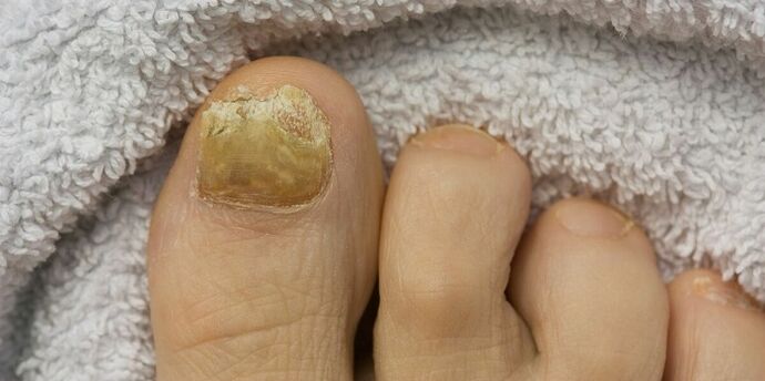 žlté nechty na nohách s plesňovou infekciou