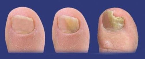 fázy vývoja huby na nechtoch nôh